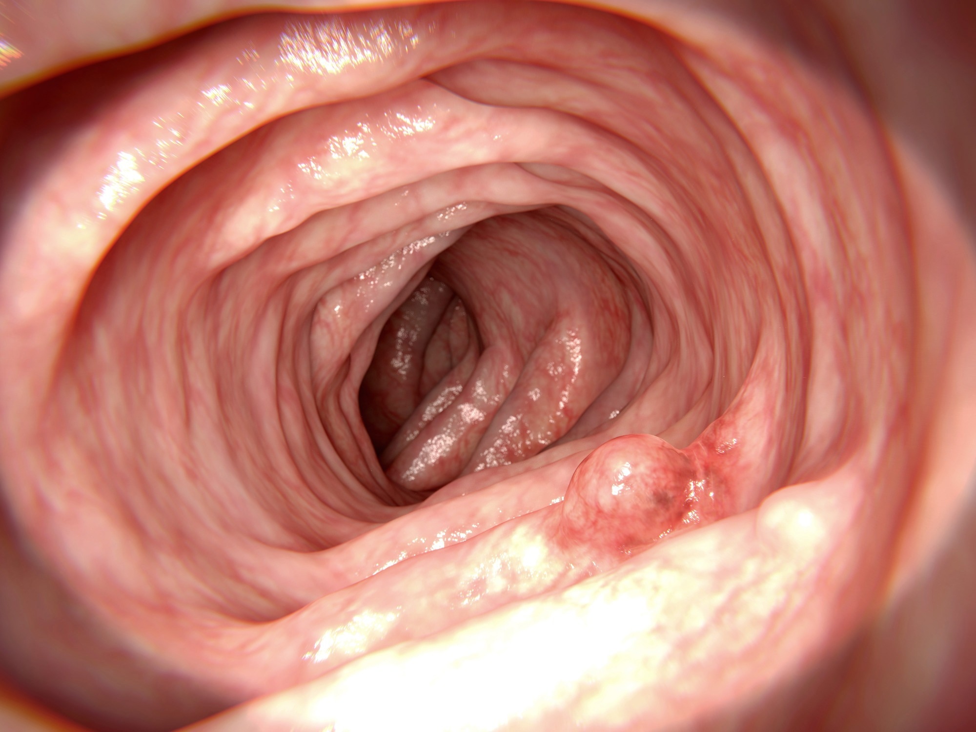 Report: Long-lasting gut microbiome and fecal metabolome alterations after colorectal adenoma removal and their relationship to colorectal cancer. Image Credit: Juan Gaertner / Shutterstock