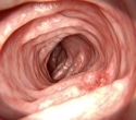 Gut changes linger years after polyp removal and may signal colorectal cancer risk