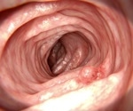 Gut changes linger years after polyp removal and may signal colorectal cancer risk