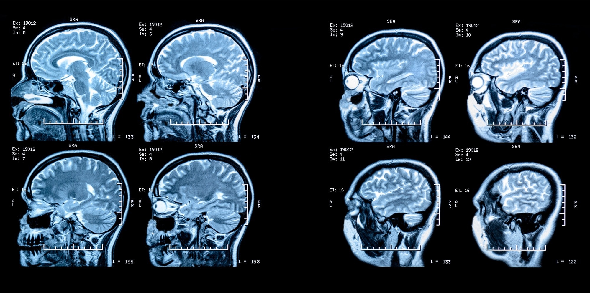 Efficacy and safety of a bodyweight–adjusted higher dose of ocrelizumab in relapsing (MUSETTE) and primary progressive (GAVOTTE) multiple sclerosis: two multicentre, randomised, double-blind, parallel-group phase 3b trials. Image Credit: Camptoloma / Shutterstock