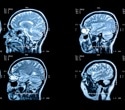 Higher-dose ocrelizumab depletes more B cells but does not slow MS progression