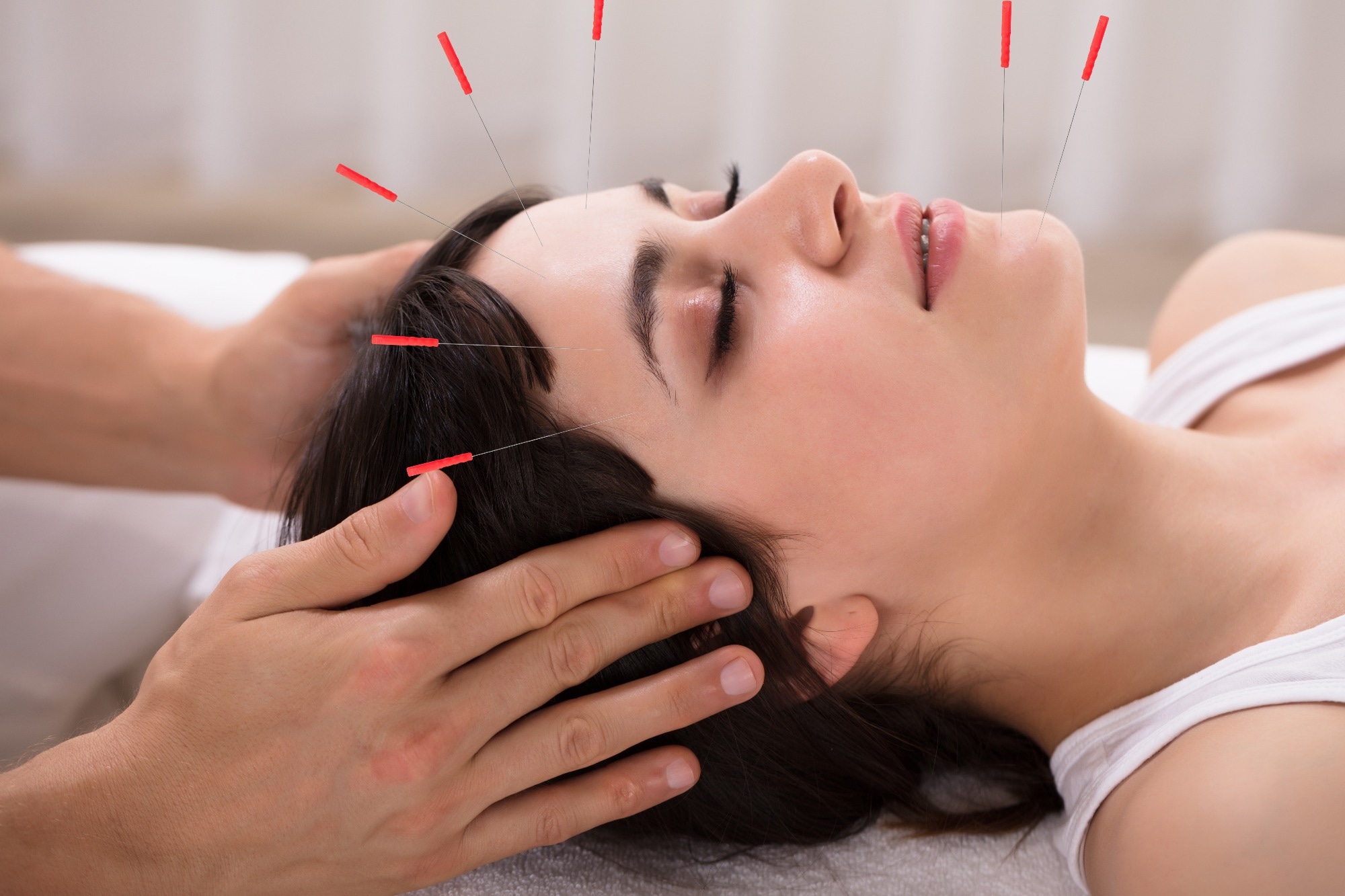 Relaxed Young Woman Receiving Acupuncture Treatment