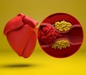 GLP-1 medicines may cut clot-related risks in chronically inflamed patients