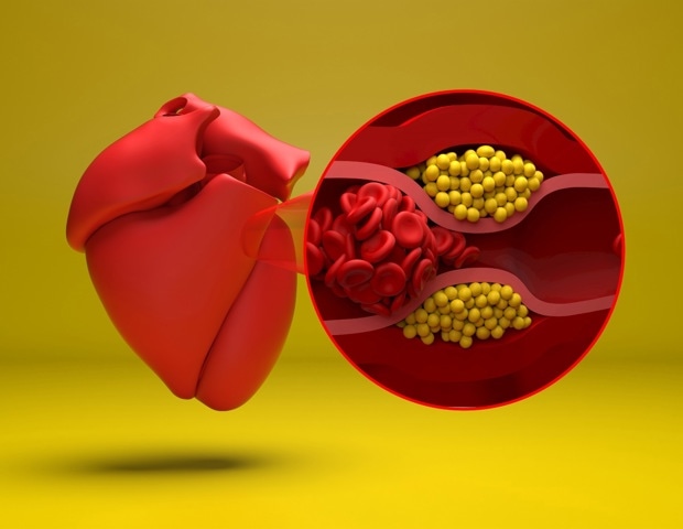 GLP-1 medicines may cut clot-related risks in chronically inflamed patients