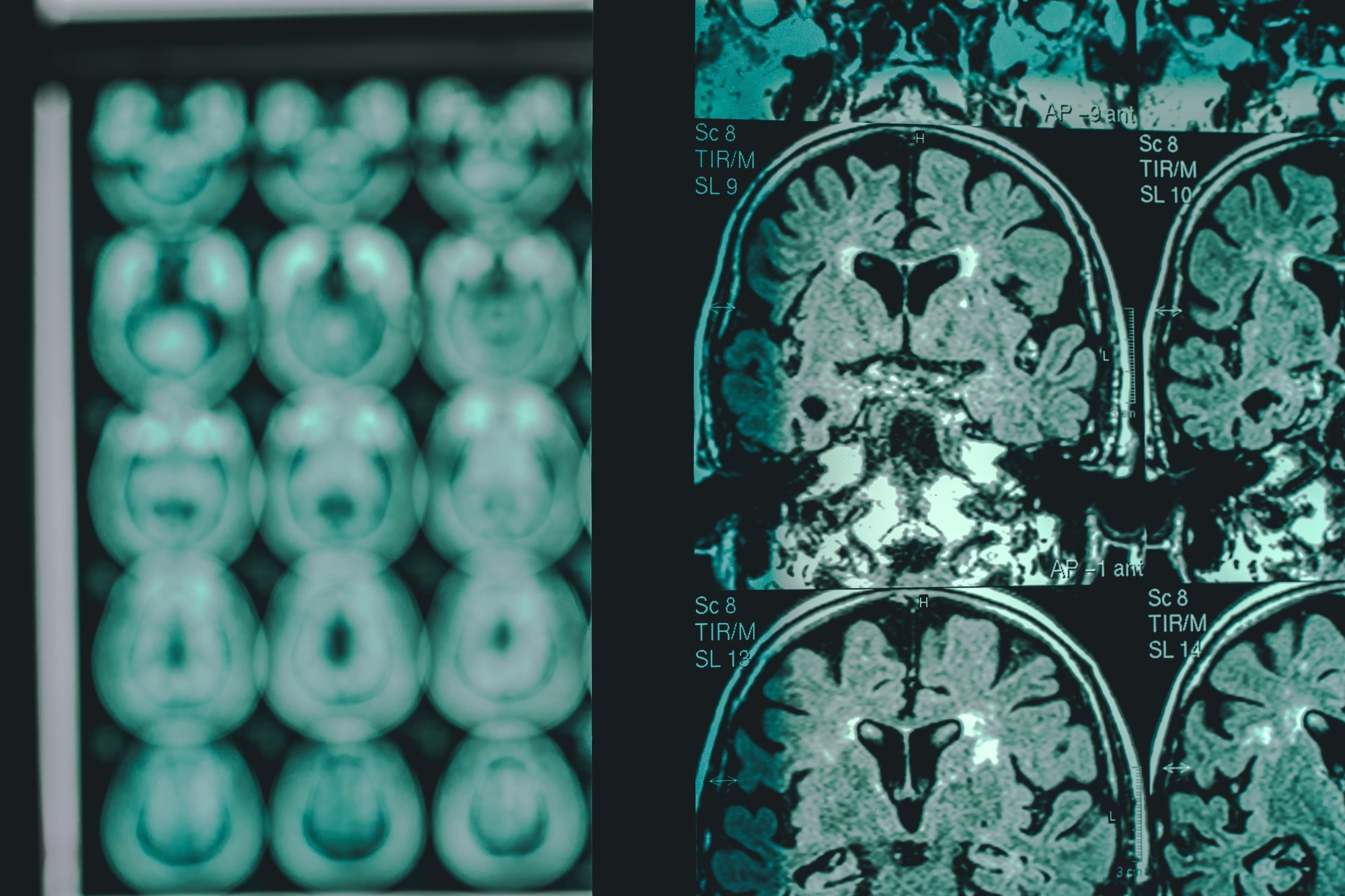 Glucosamine may worsen Alzheimer’s by fueling abnormal brain glycosylation