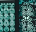 Glucosamine may worsen Alzheimer’s by fueling abnormal brain glycosylation