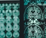 Glucosamine may worsen Alzheimer’s by fueling abnormal brain glycosylation