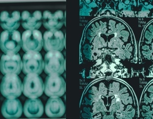 Glucosamine may worsen Alzheimer’s by fueling abnormal brain glycosylation