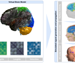 Digital brain twin recreates brain activity in a toddler with autism