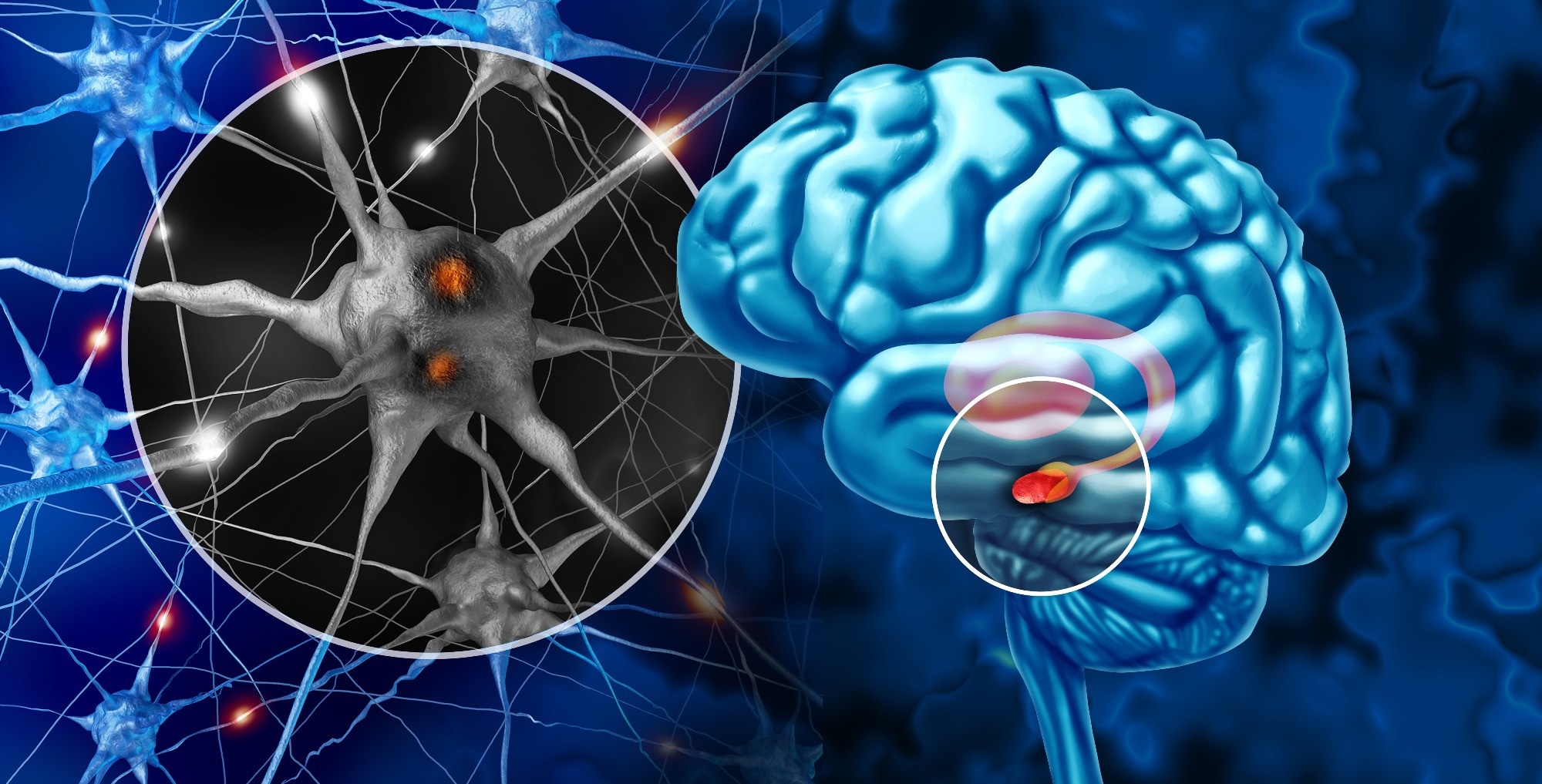 Short sleep and poor sleep quality track with Parkinson’s risk