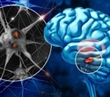 Short sleep and poor sleep quality track with Parkinson’s risk