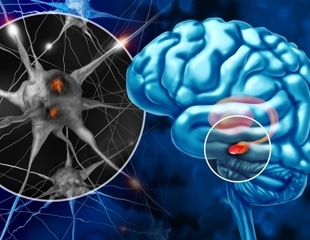 Short sleep and poor sleep quality track with Parkinson’s risk