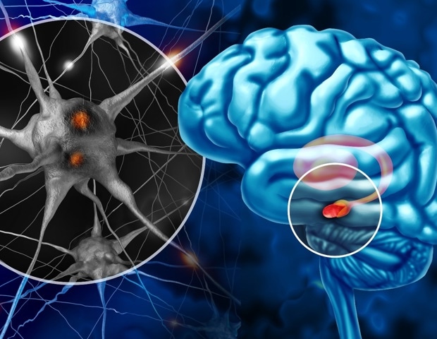 Short sleep and poor sleep quality track with Parkinson’s risk