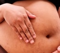 GLP-1 exposure in pregnancy does not clearly raise major birth defect risk
