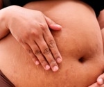 GLP-1 exposure in pregnancy does not clearly raise major birth defect risk