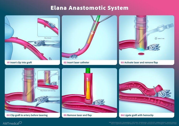 A breakthrough in coronary bypass surgery: AMT Medical’s SAFE-CAB results published in The Journal of Thoracic and Cardiovascular Surgery