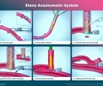 A breakthrough in coronary bypass surgery: AMT Medical’s SAFE-CAB results published in The Journal of Thoracic and Cardiovascular Surgery