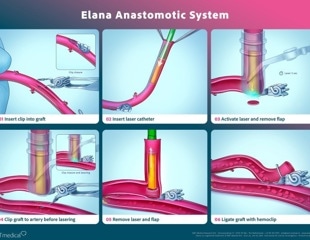 A breakthrough in coronary bypass surgery: AMT Medical’s SAFE-CAB results published in The Journal of Thoracic and Cardiovascular Surgery