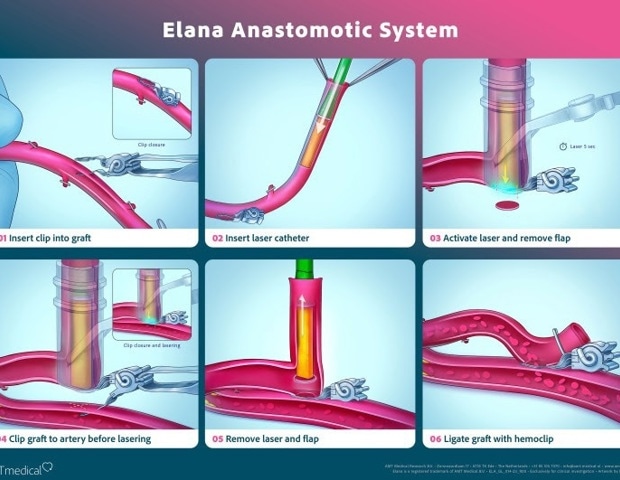 A breakthrough in coronary bypass surgery: AMT Medical’s SAFE-CAB results published in The Journal of Thoracic and Cardiovascular Surgery