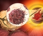 Red meat intake emerges as a potential pancreatic cancer risk factor