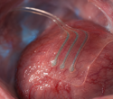 Bioresorbable Sensor Tracks Deep-Tissue Lactate for Over 10 Days in Animals