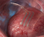Bioresorbable sensor tracks deep-tissue lactate for over 10 days in animals