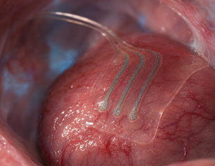 Bioresorbable sensor tracks deep-tissue lactate for over 10 days in animals