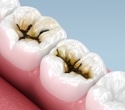 Large US trial supports silver diamine fluoride for severe early childhood caries