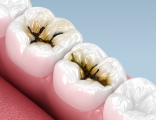 Large US trial supports silver diamine fluoride for severe early childhood caries