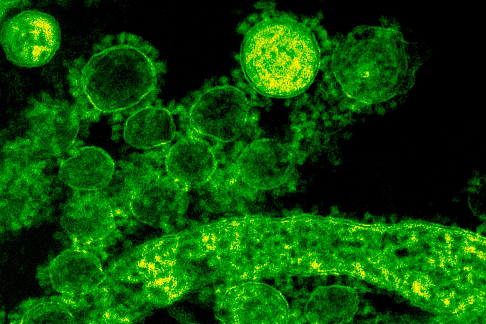 Study: Virus reactivation in acute and long COVID-19. Image Credit: Rawpixel.com / Shutterstock
