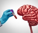 Semaglutide slows blood protein signature linked to future dementia risk