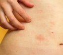 Paying attention to your body may change how an acute skin inflammation unfolds
