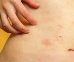 Paying attention to your body may change how an acute skin inflammation unfolds