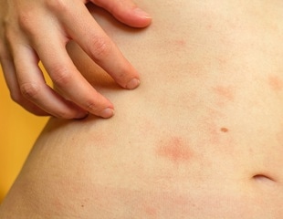Paying attention to your body may change how an acute skin inflammation unfolds