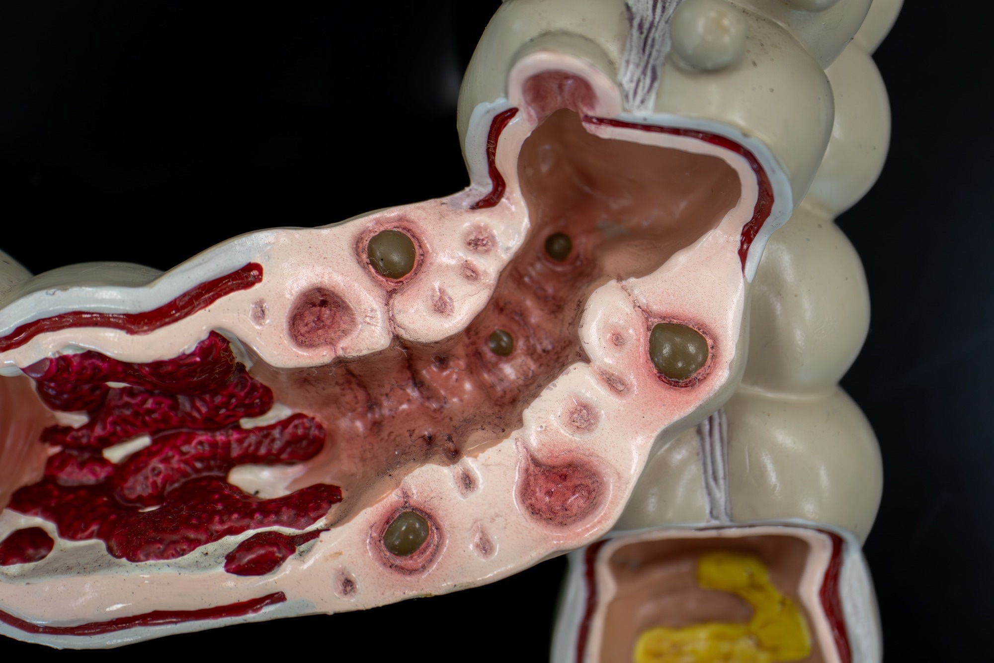 Study: Significant alteration of gut microbiota in patients with symptomatic uncomplicated diverticular disease. Image Credit: DrWD40 / Shutterstock