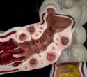 Scientists found a distinct gut microbiome pattern in people with symptomatic diverticular disease