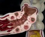 Scientists found a distinct gut microbiome pattern in people with symptomatic diverticular disease