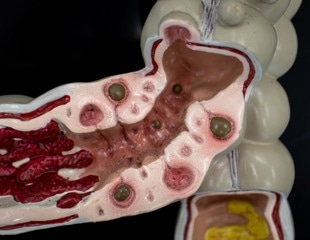 Scientists found a distinct gut microbiome pattern in people with symptomatic diverticular disease