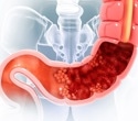 Coffee after colorectal cancer? Decaf and caffeine show different links with mortality
