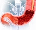 Coffee after colorectal cancer? Decaf and caffeine show different links with mortality