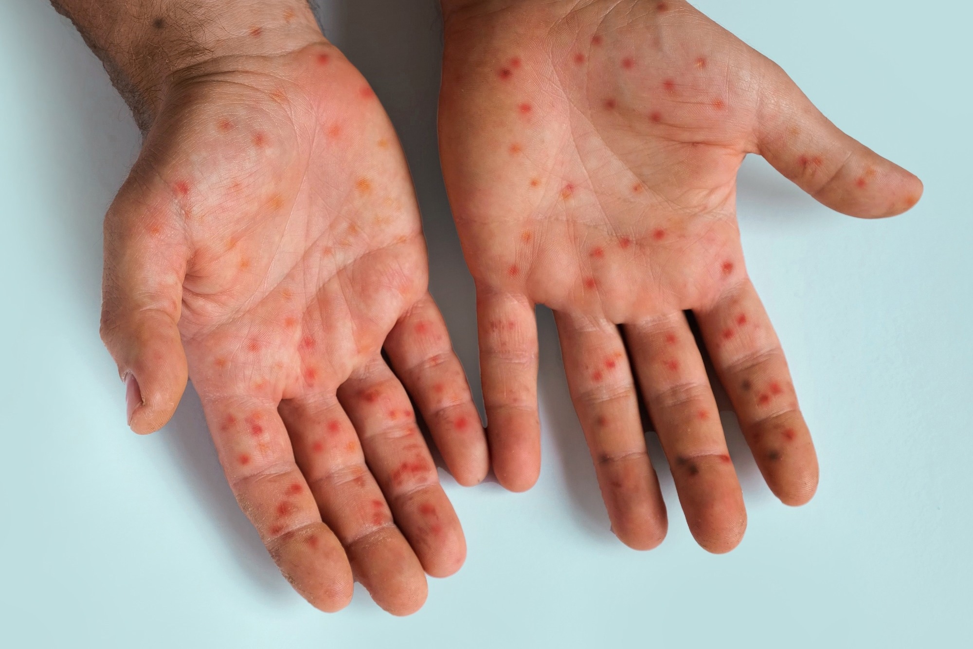Measles outbreaks may reveal more than gaps in vaccination