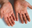 Measles outbreaks may reveal more than gaps in vaccination
