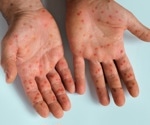 Measles outbreaks may reveal more than gaps in vaccination
