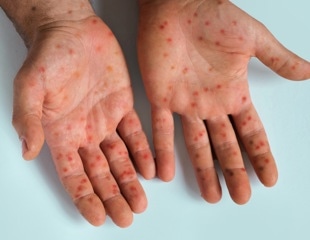 Measles outbreaks may reveal more than gaps in vaccination