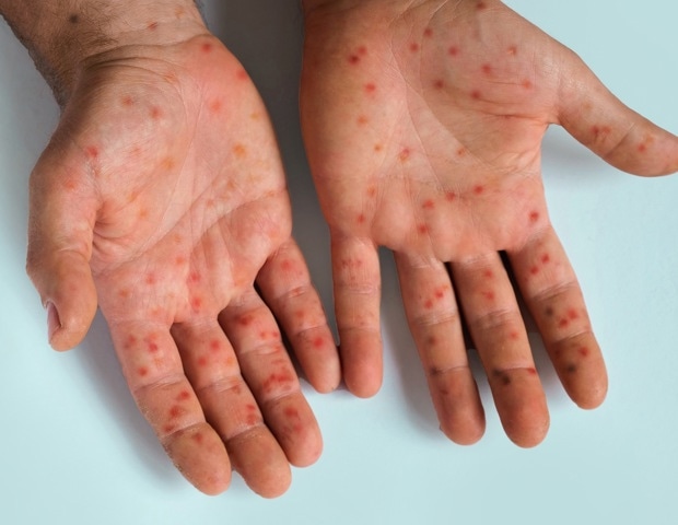 Measles outbreaks may reveal more than gaps in vaccination
