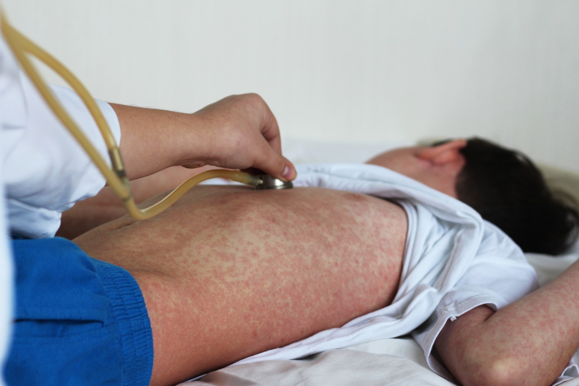Study: Predicting measles outbreak magnitude via modeled population susceptibility evidence from pre-vaccination data. Image Credit: fotohay / Shutterstock