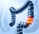 Why are more younger adults in the Eastern Mediterranean facing colorectal cancer?