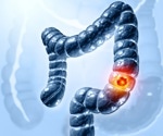 Why are more younger adults in the Eastern Mediterranean facing colorectal cancer?