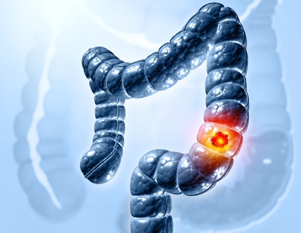 Why are more younger adults in the Eastern Mediterranean facing colorectal cancer?