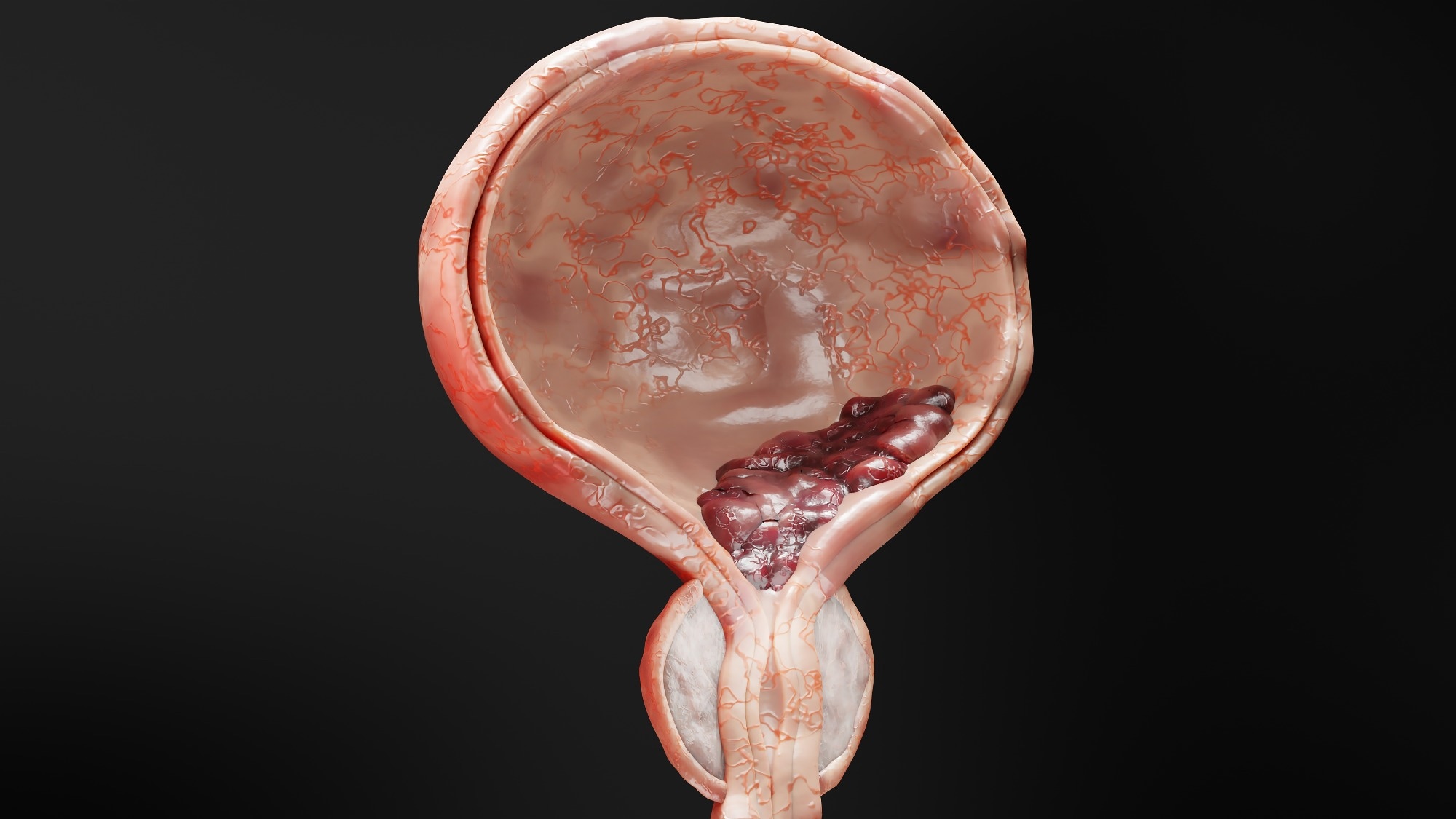 Bladder cancer stages. ancerous cells, malignant tumor compresses urethra. Pathological disruption, genital reproductive system anatomy, bladder Oncological or Urological Disease, bph, 3d render